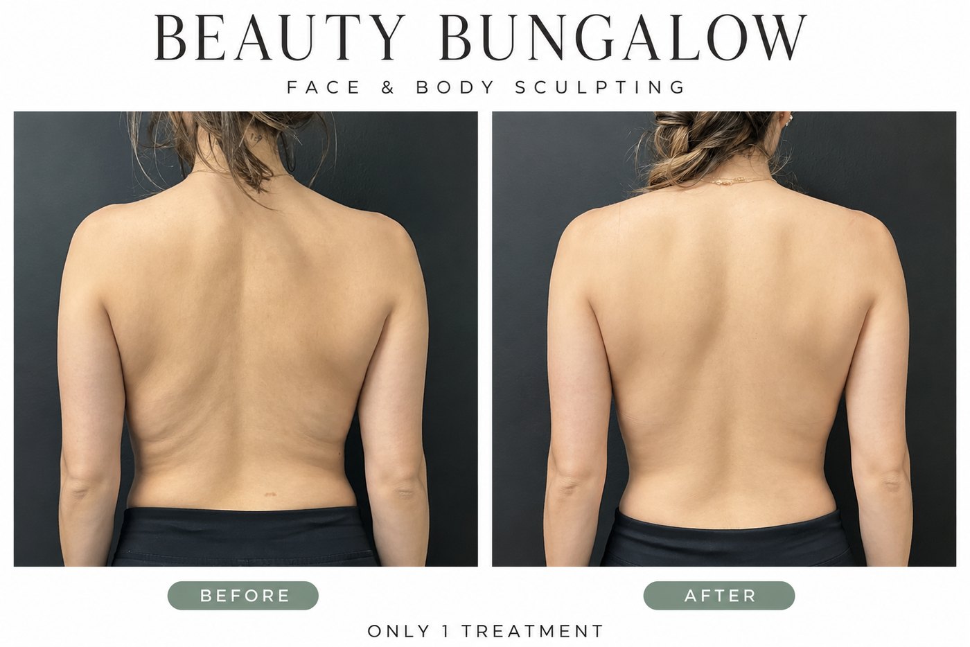 Beauty Bungalow EON before and after: back and bra line after one treatment