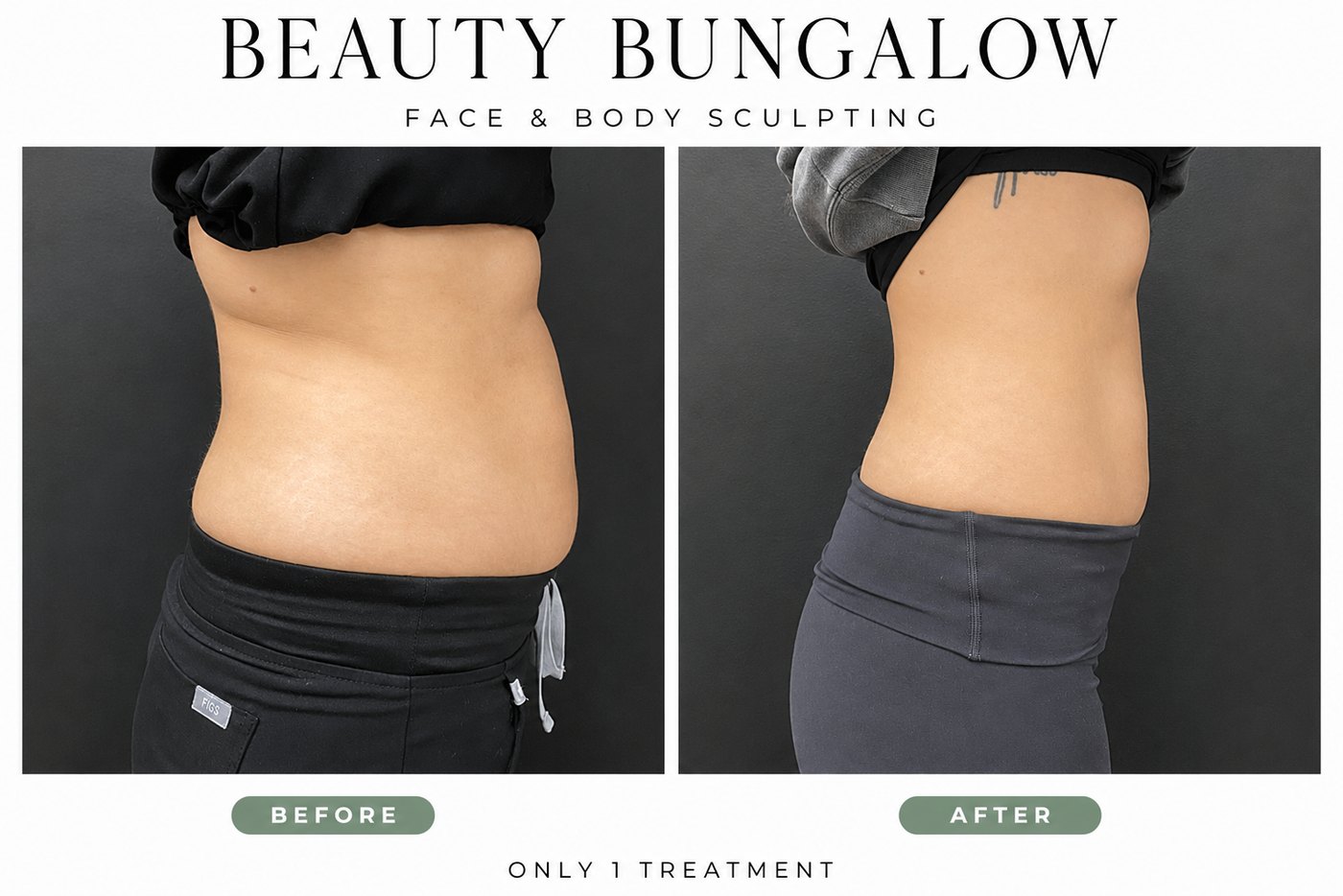 Beauty Bungalow EON before and after: abdomen and flanks side view after one treatment