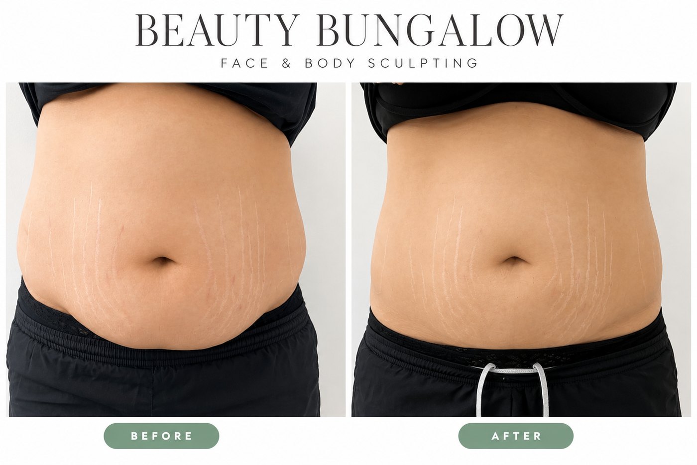 Beauty Bungalow EON before and after: abdomen front view