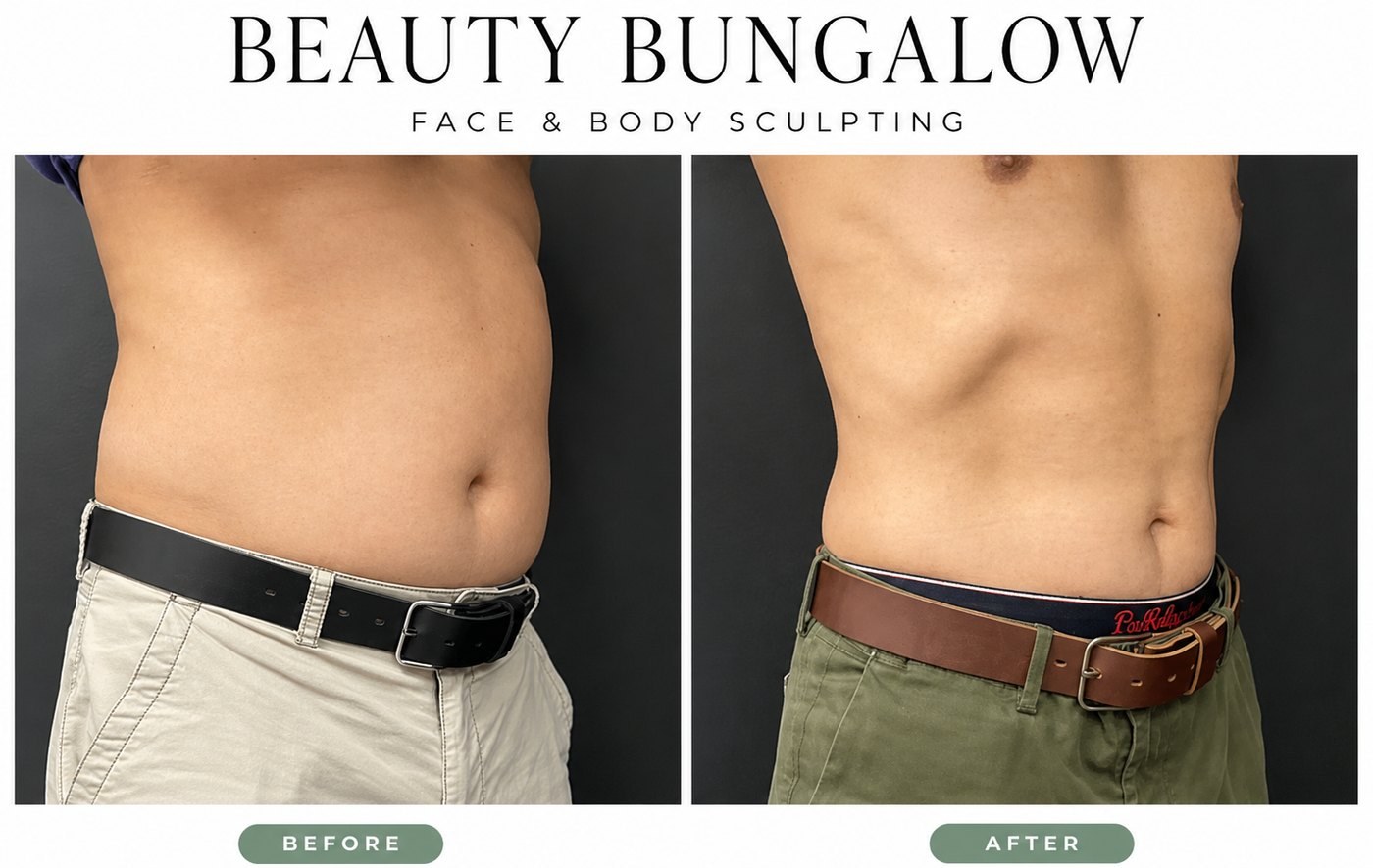 Beauty Bungalow EON before and after: male abdomen side view, belt tightened