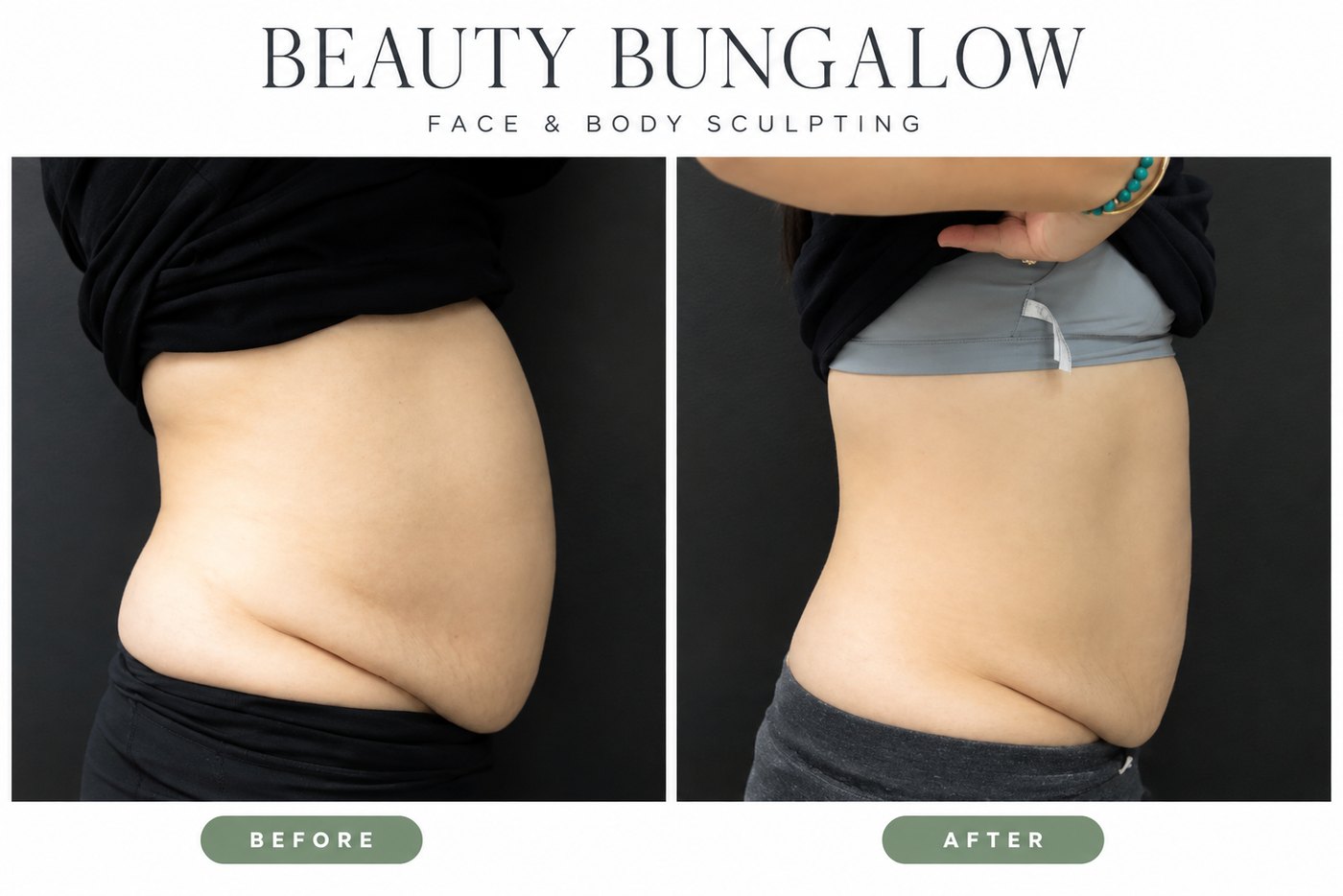 Beauty Bungalow EON before and after: abdomen and waist in side profile, visibly flatter after one treatment