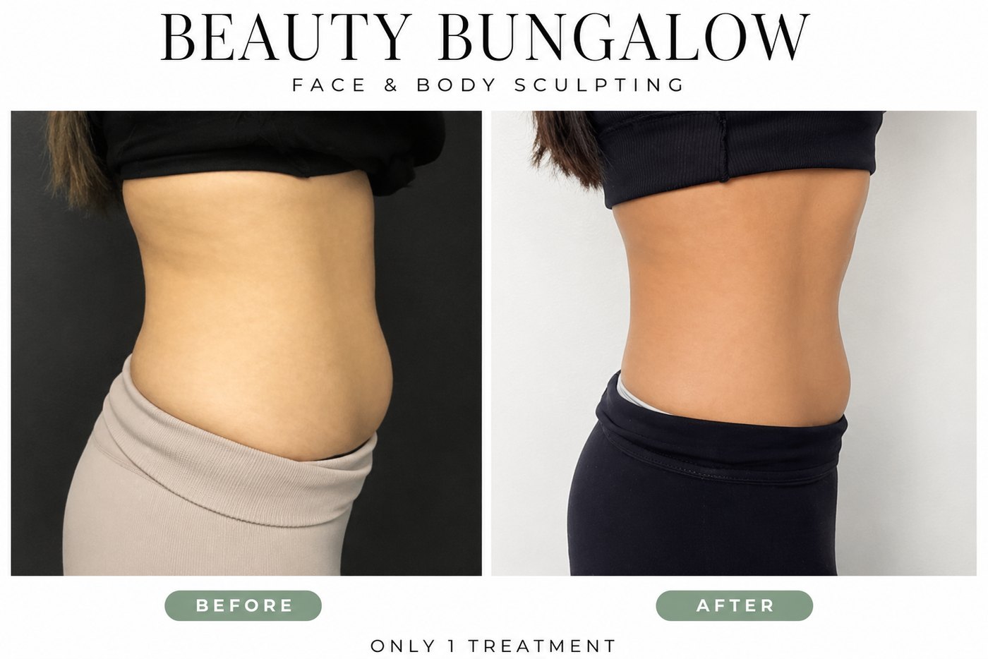 Beauty Bungalow EON before and after: lower abdomen side view after one treatment