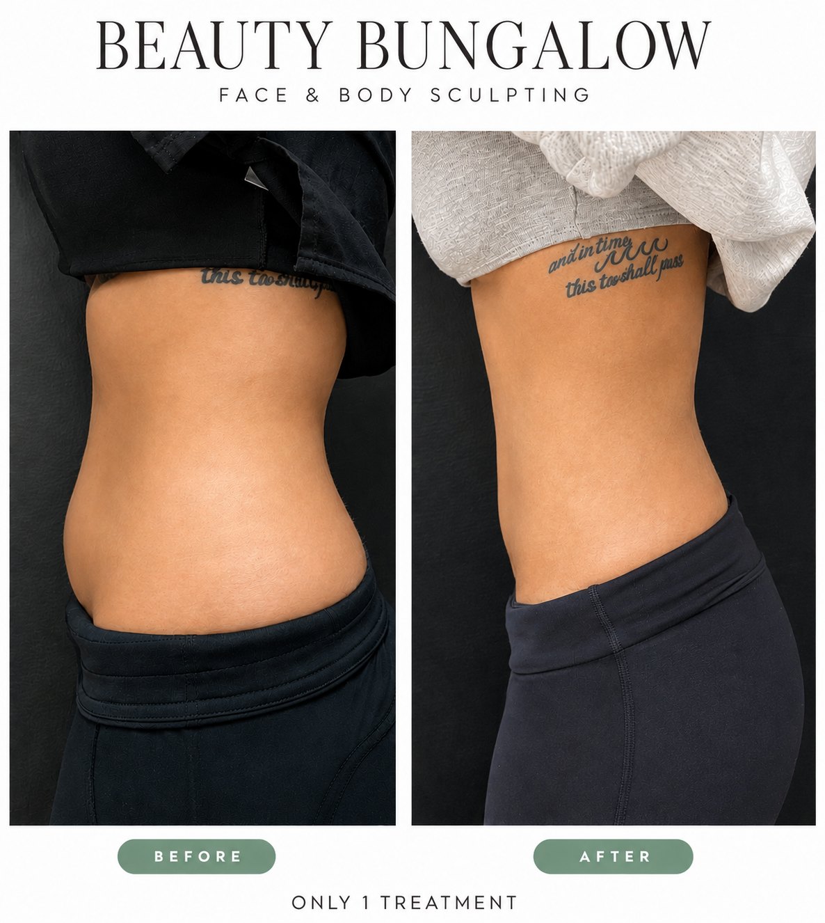 Beauty Bungalow EON before and after: waistline side view after one treatment