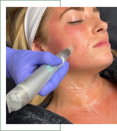 Beauty-Bungalow -Microneedling with Peptides