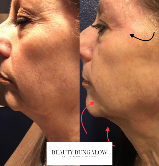 Beauty-Bungalow - Ultimate Reform Facial (DermaFace + PRP Microneedling)