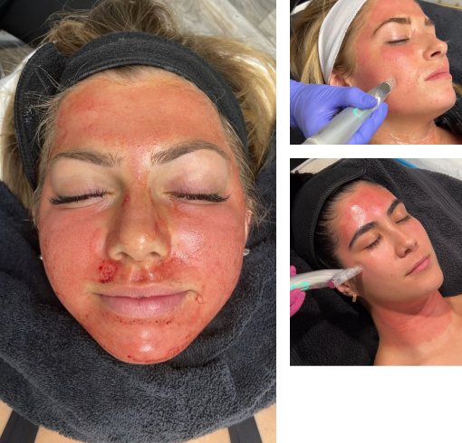 Beauty-Bungalow - Microneedling with PRP