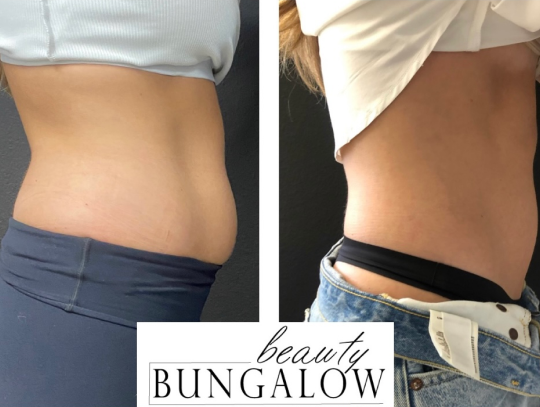 Beauty-Bungalow - EON Laser - Before and After 9