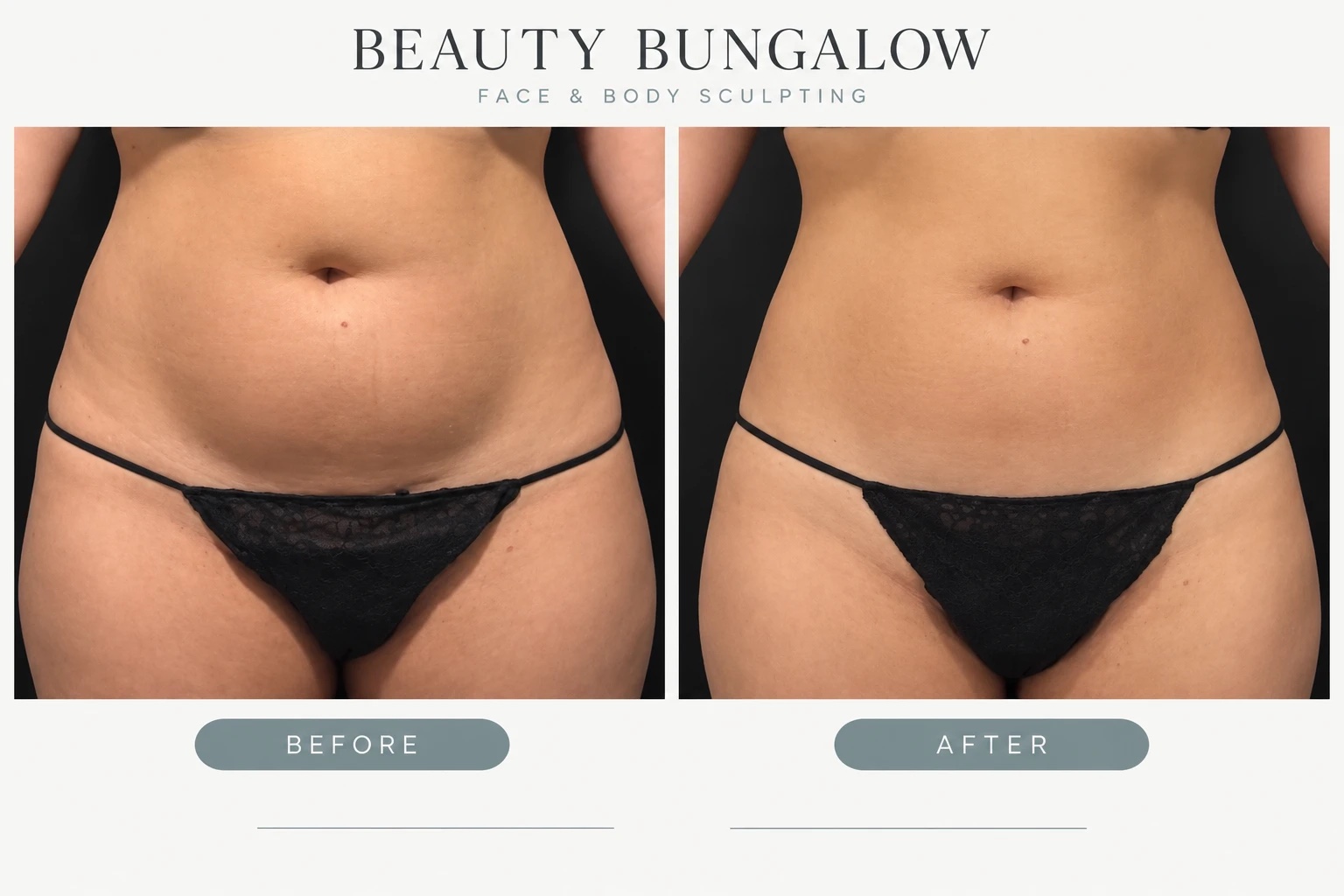 EON Laser before and after — stomach, front view