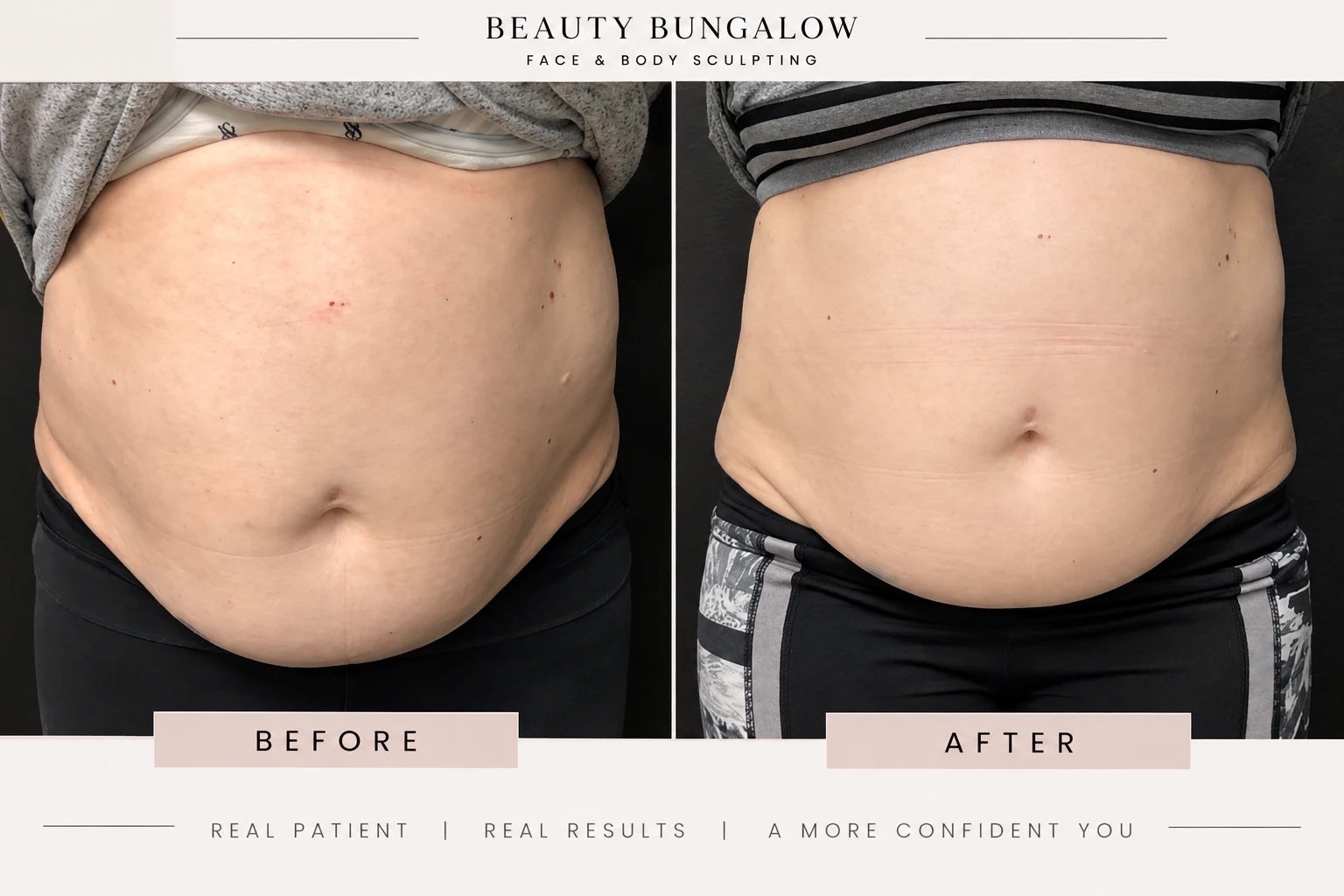 EON Laser before and after — abdomen, front view