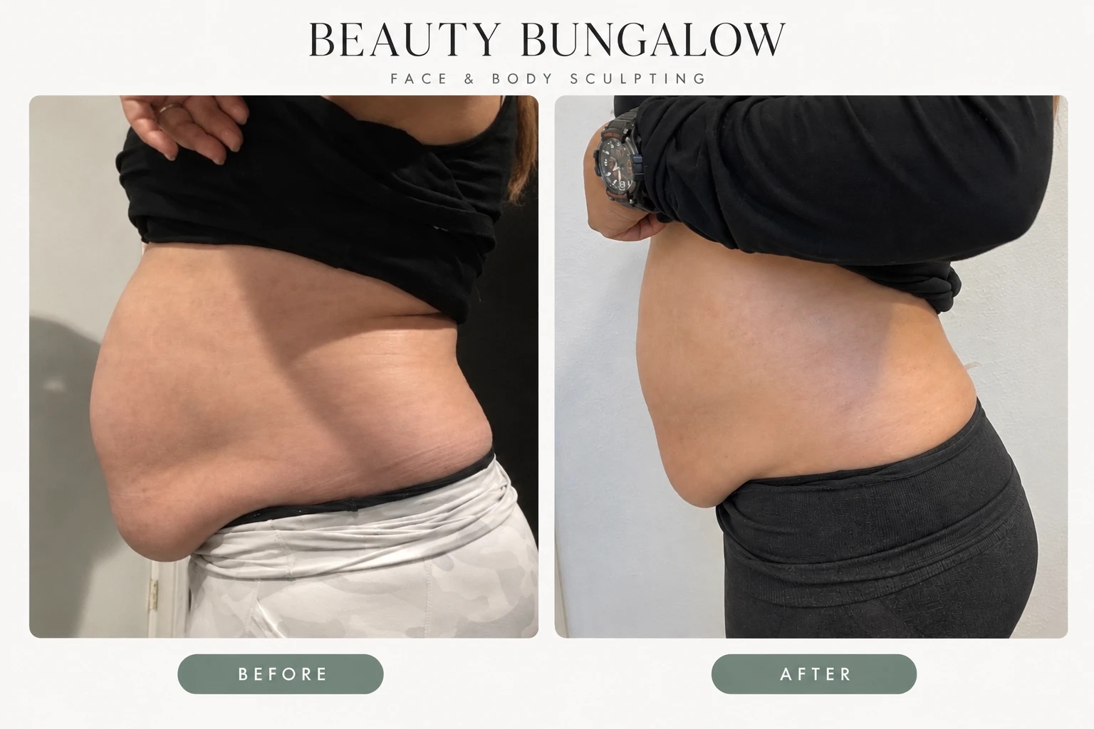 EON laser before and after: abdomen dramatically reduced, side view, Beauty Bungalow patient
