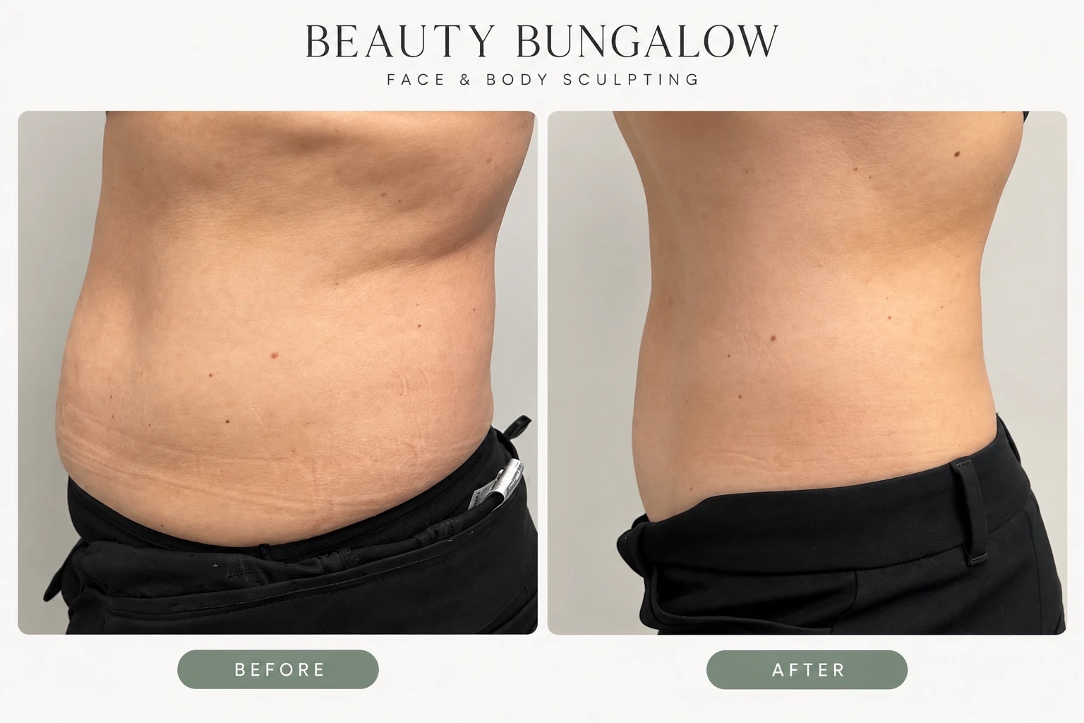 EON Laser before and after — waist & lower abdomen