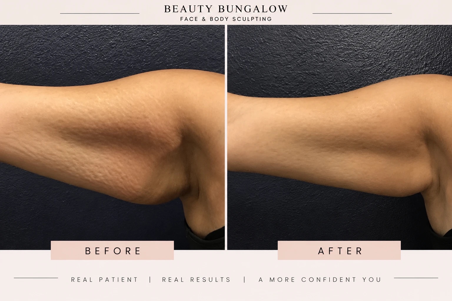 Non-surgical arm sculpting before and after — upper arm, smoothed & toned