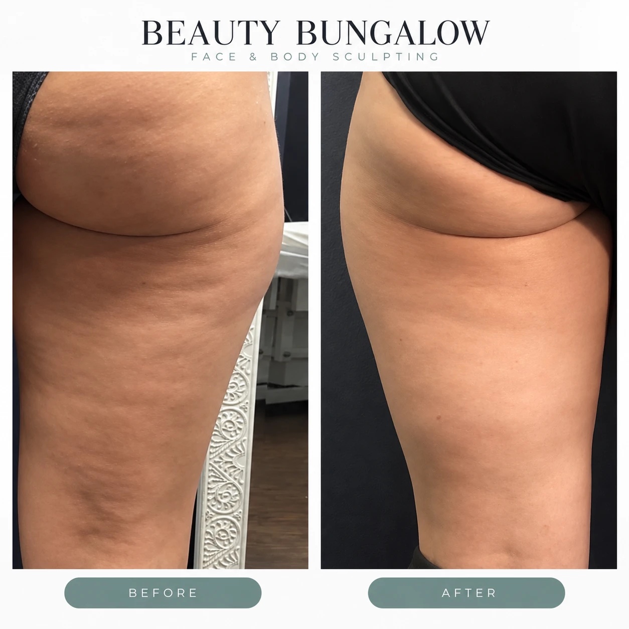 EON Laser before and after — thighs & glutes