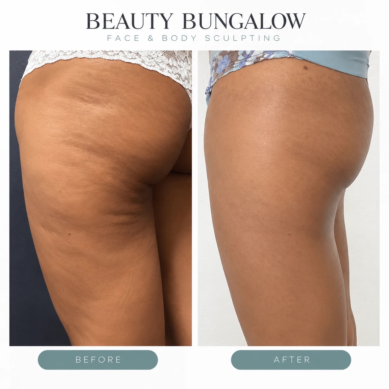 EON Laser before and after — thighs