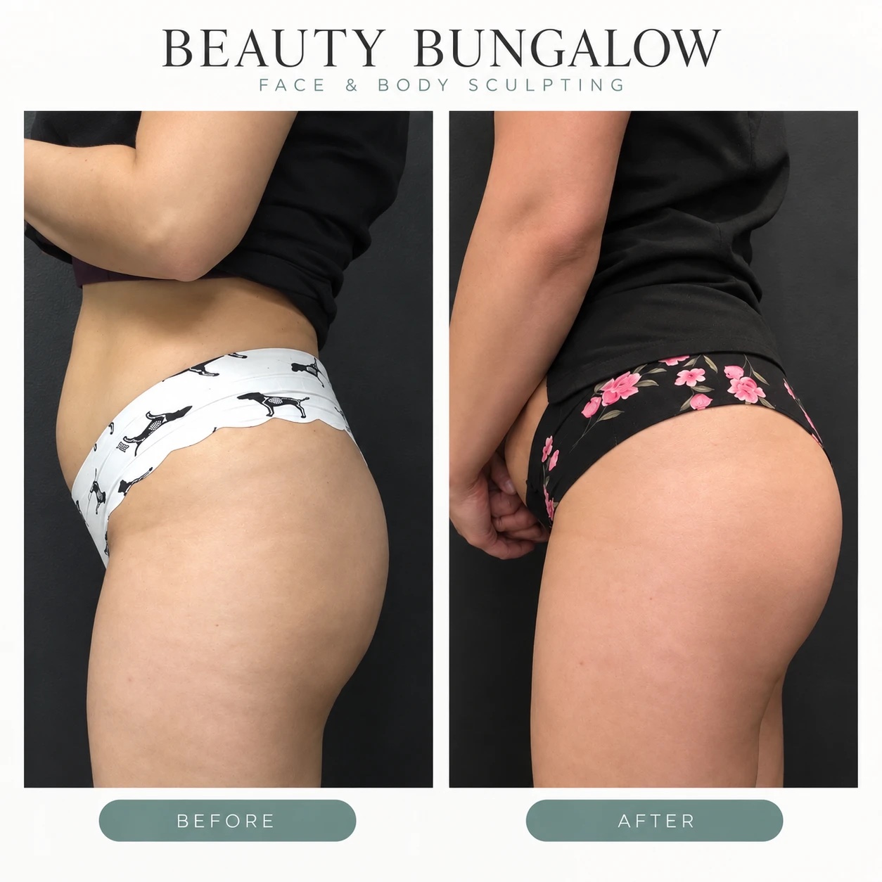 Non-surgical butt lift before and after — glutes, lifted & toned