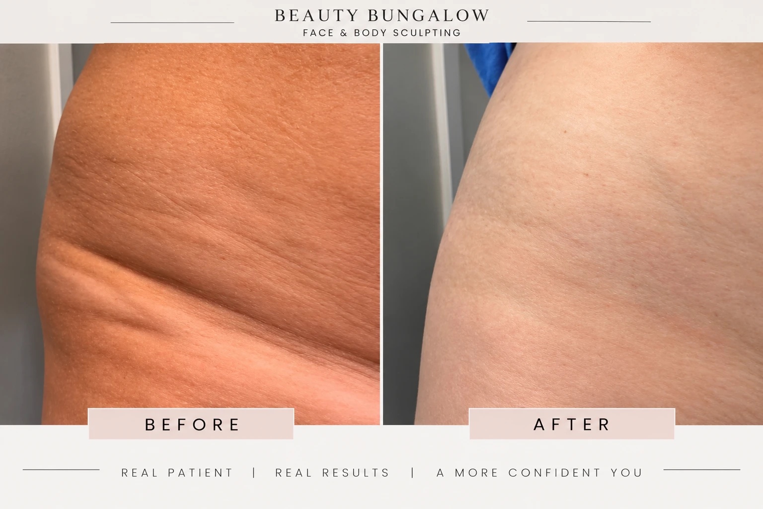 Cellulite smoothing before and after — outer thigh, skin texture