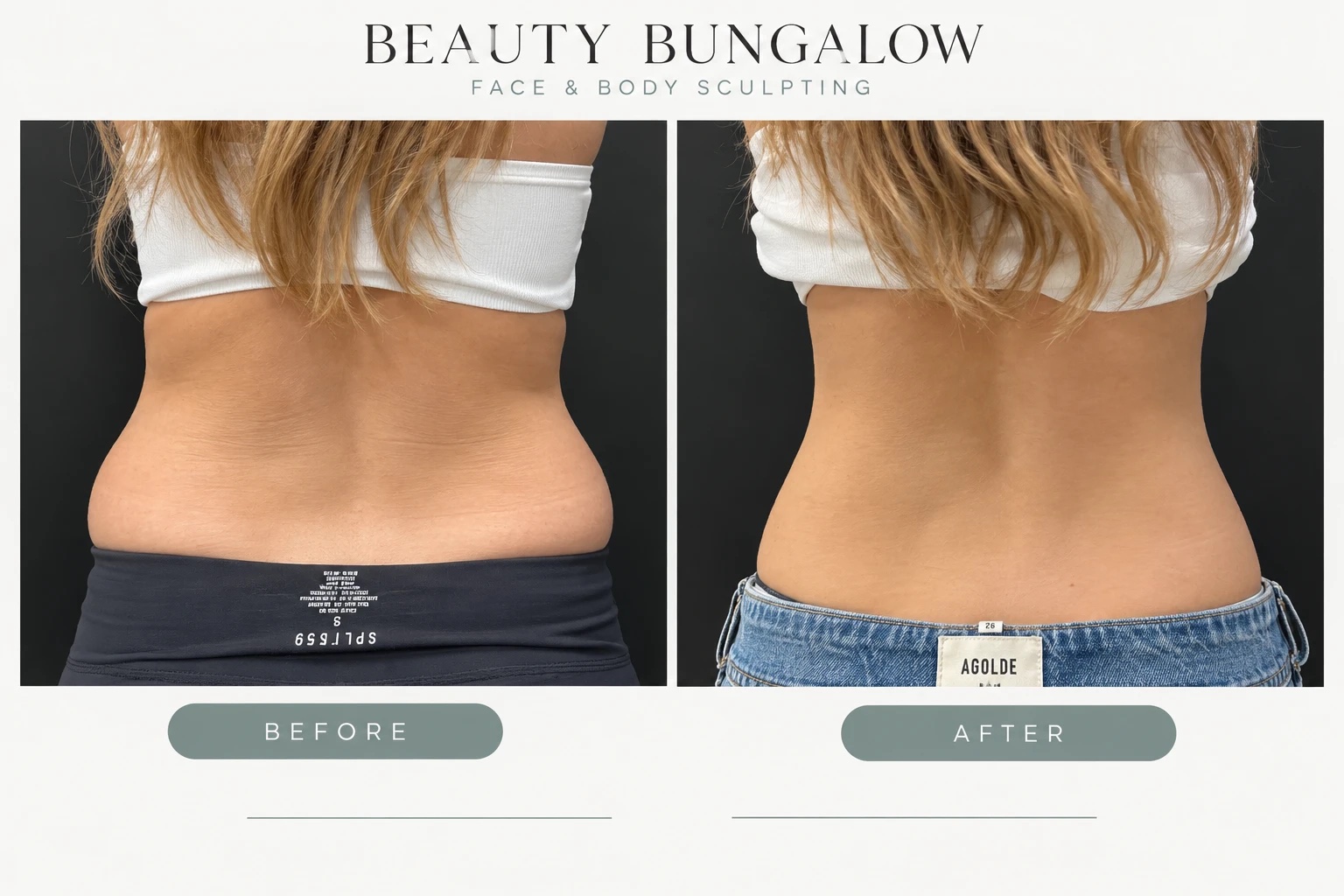 EON Laser before and after — lower back & waist