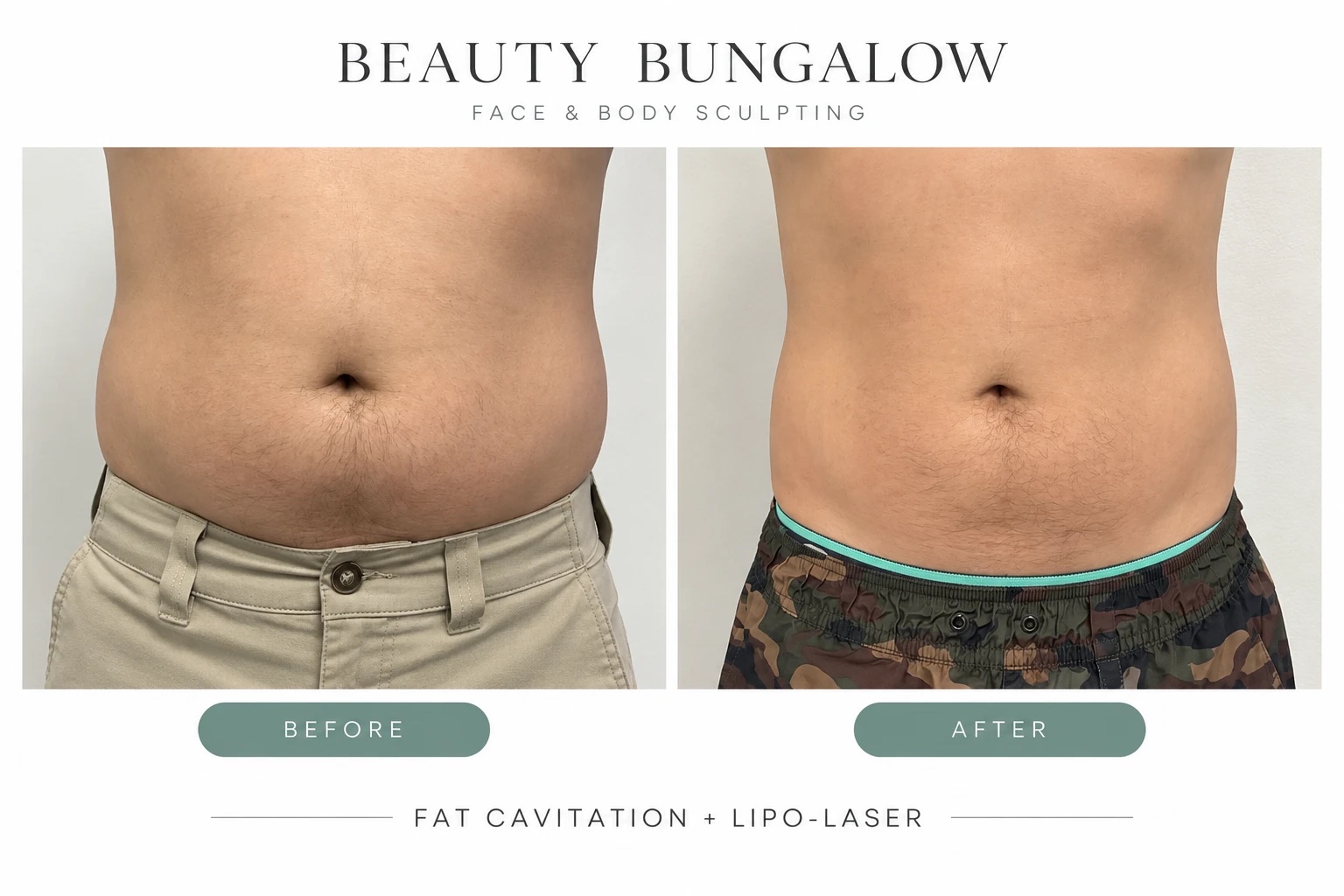Fat cavitation and lipo-laser before and after — male abdomen, front view