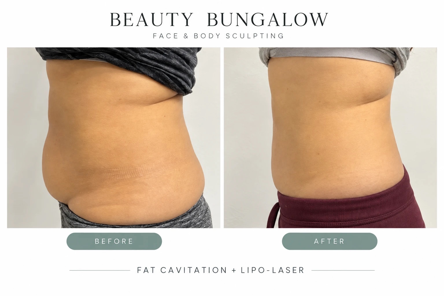 Fat cavitation and lipo-laser before and after — abdomen & waist, side view