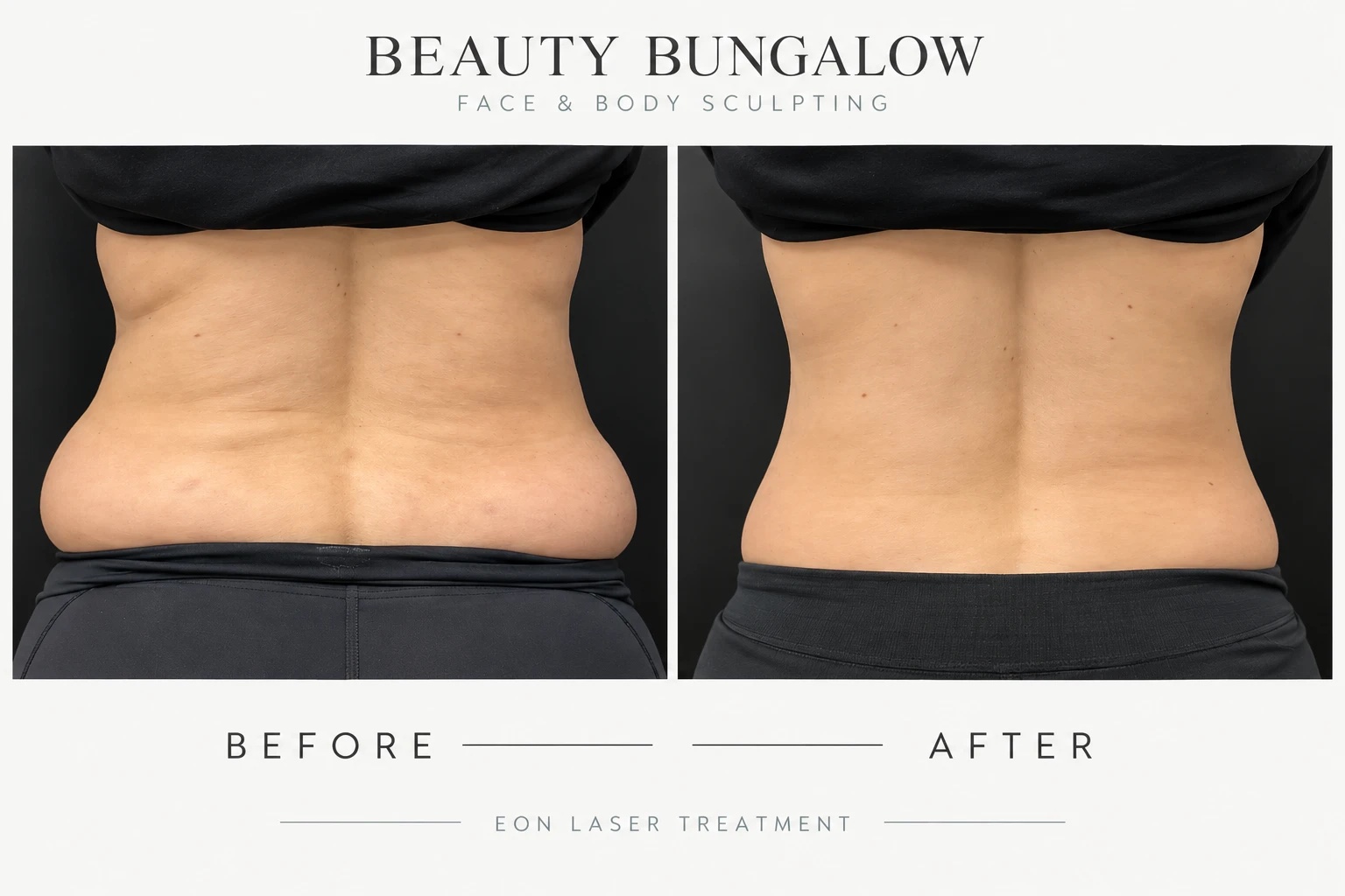 EON Laser before and after — lower back & love handles