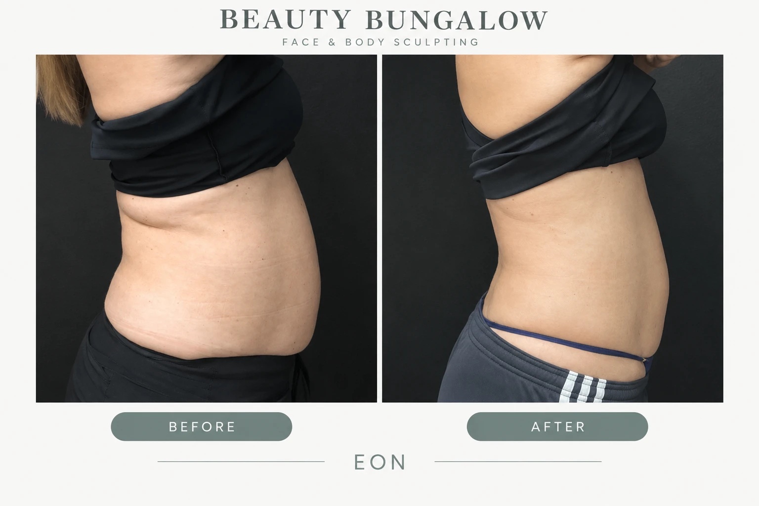 EON Laser before and after — abdomen & waist, side view