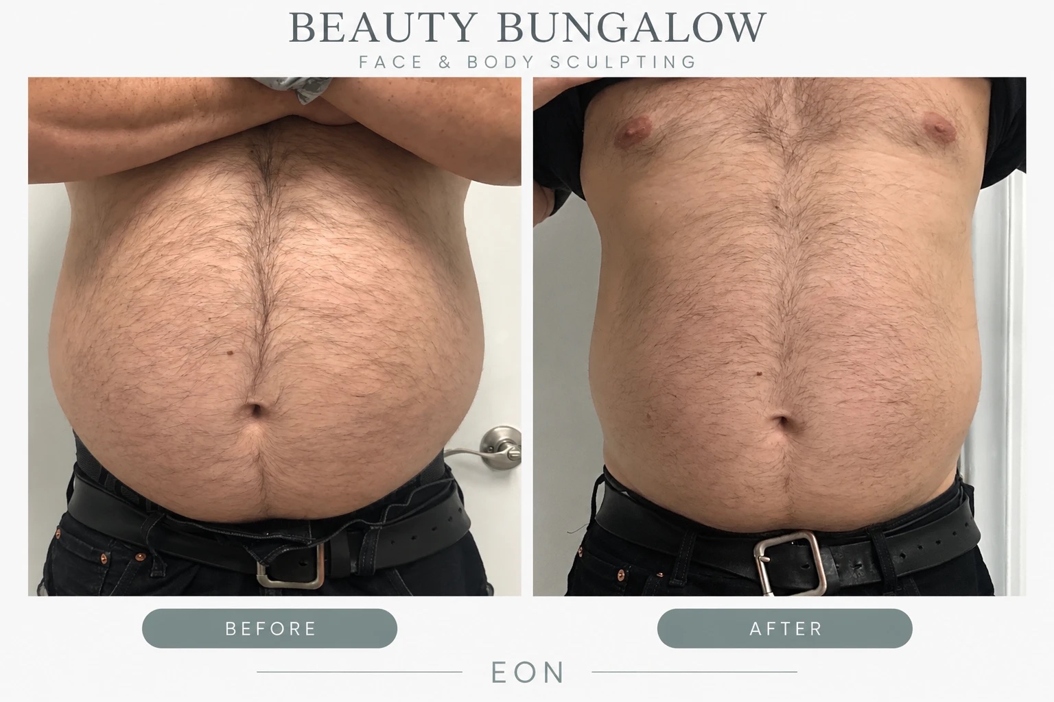 EON Laser before and after — male abdomen, front view