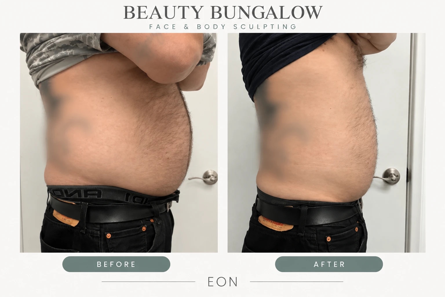 EON Laser before and after — male abdomen, side view