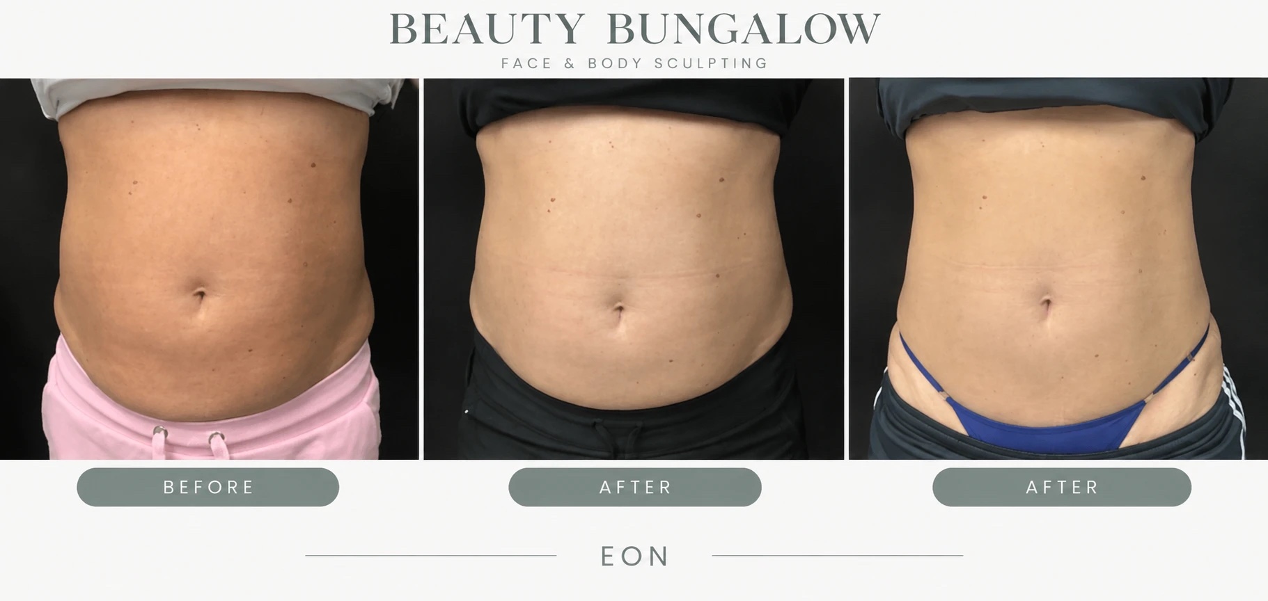 EON Laser before and after — abdomen — progress series