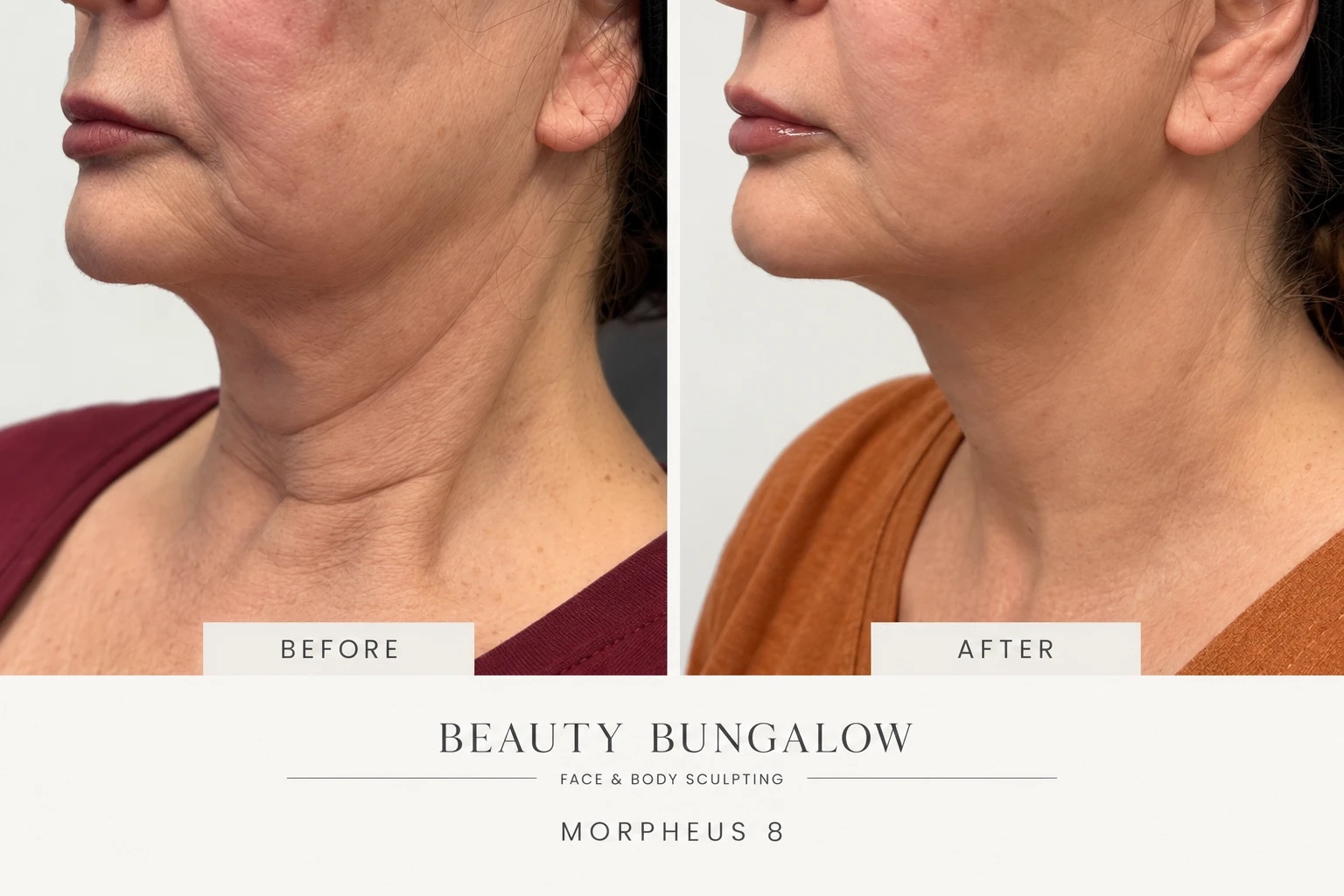 Morpheus8 before and after: jawline and neck tightened, Beauty Bungalow patient