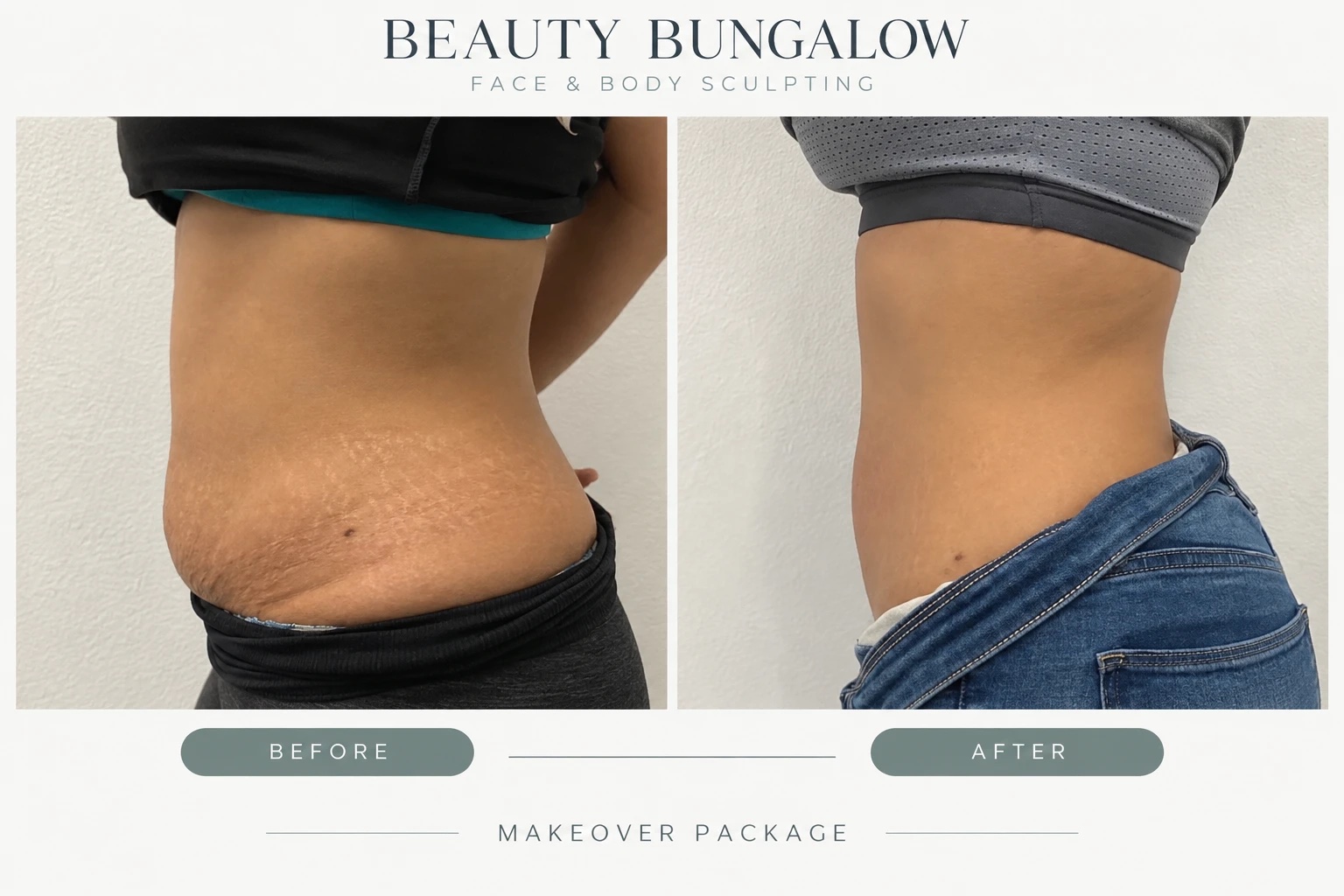 Makeover Package body transformation before and after — abdomen & waist, side view