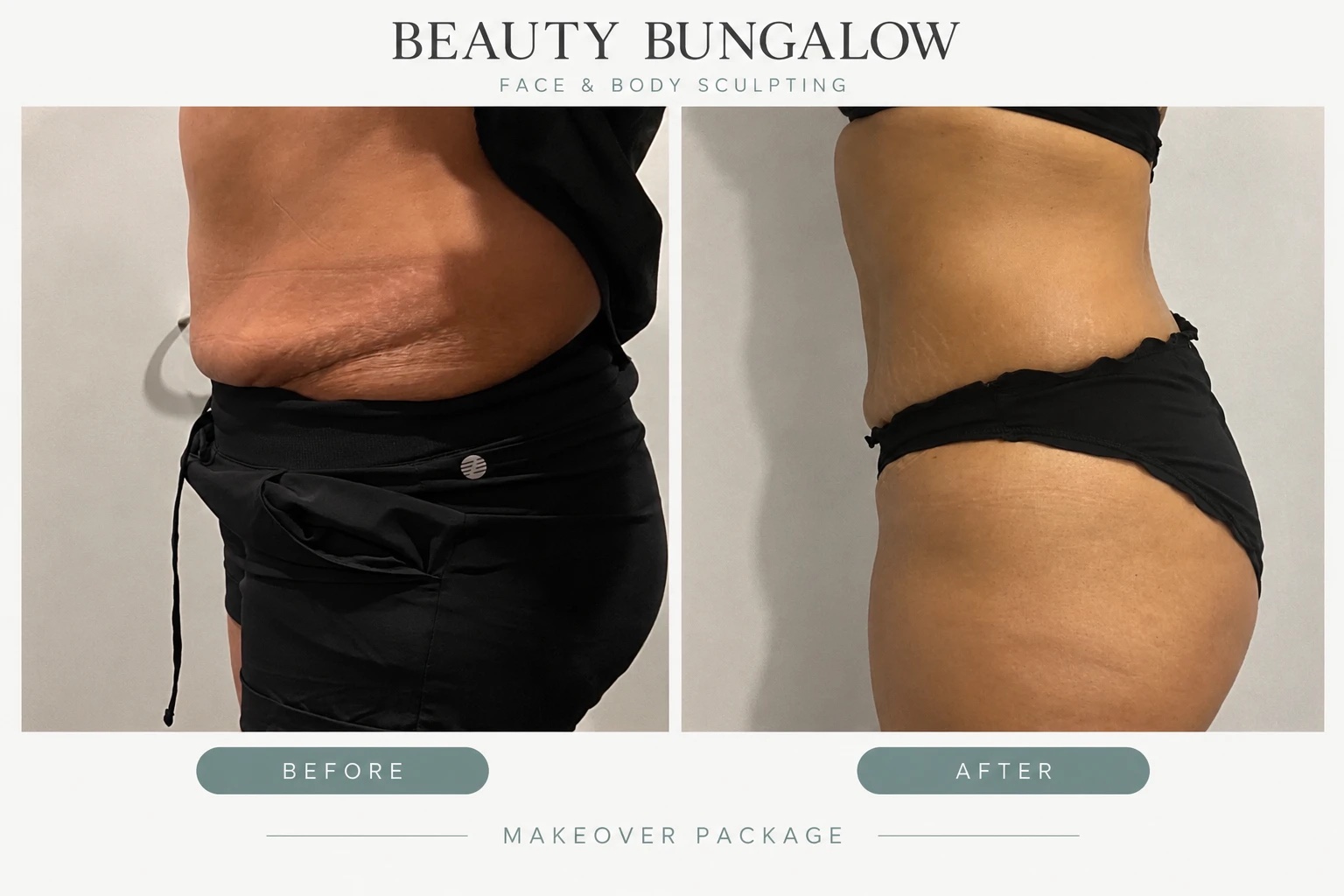 Makeover Package body transformation before and after — abdomen & hips, side view