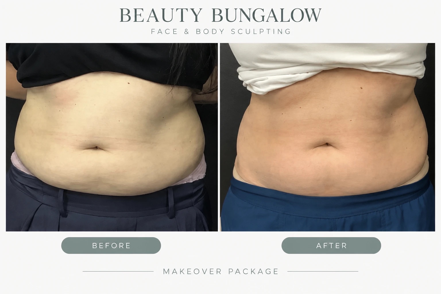 Makeover Package body transformation before and after — abdomen, front view
