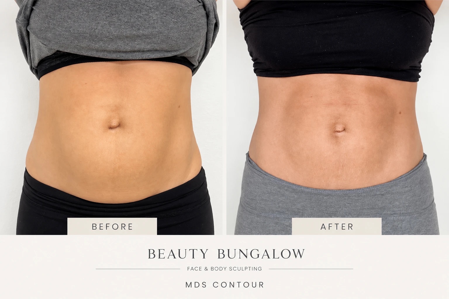 MDS Contour before and after — abdomen, front view