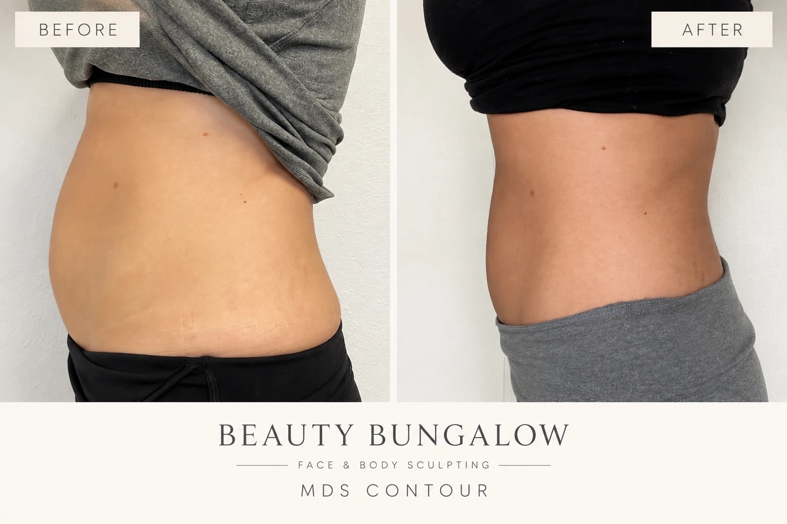 MDS Contour before and after — abdomen, side view