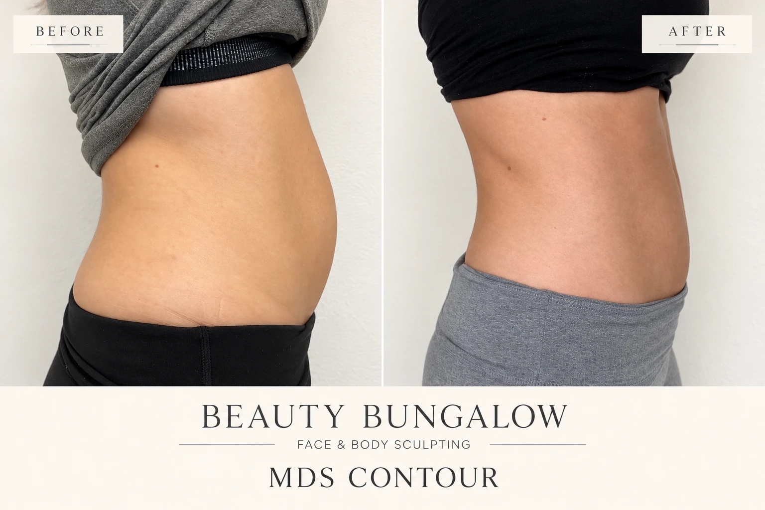 MDS Contour before and after — waistline, side view