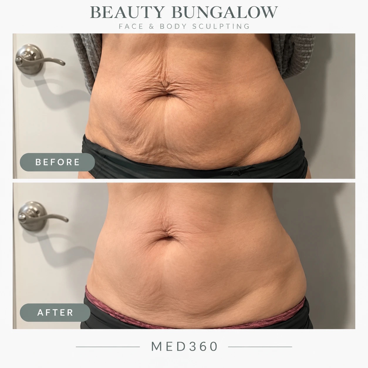 MED 360 before and after — abdomen, loose skin smoothed