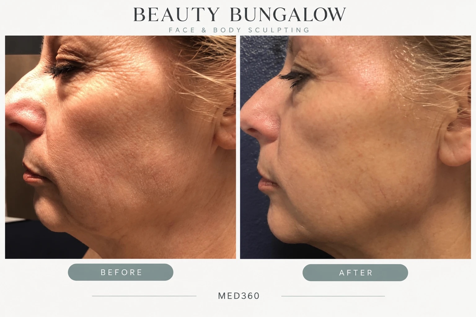 MED 360 before and after — jawline & lower face