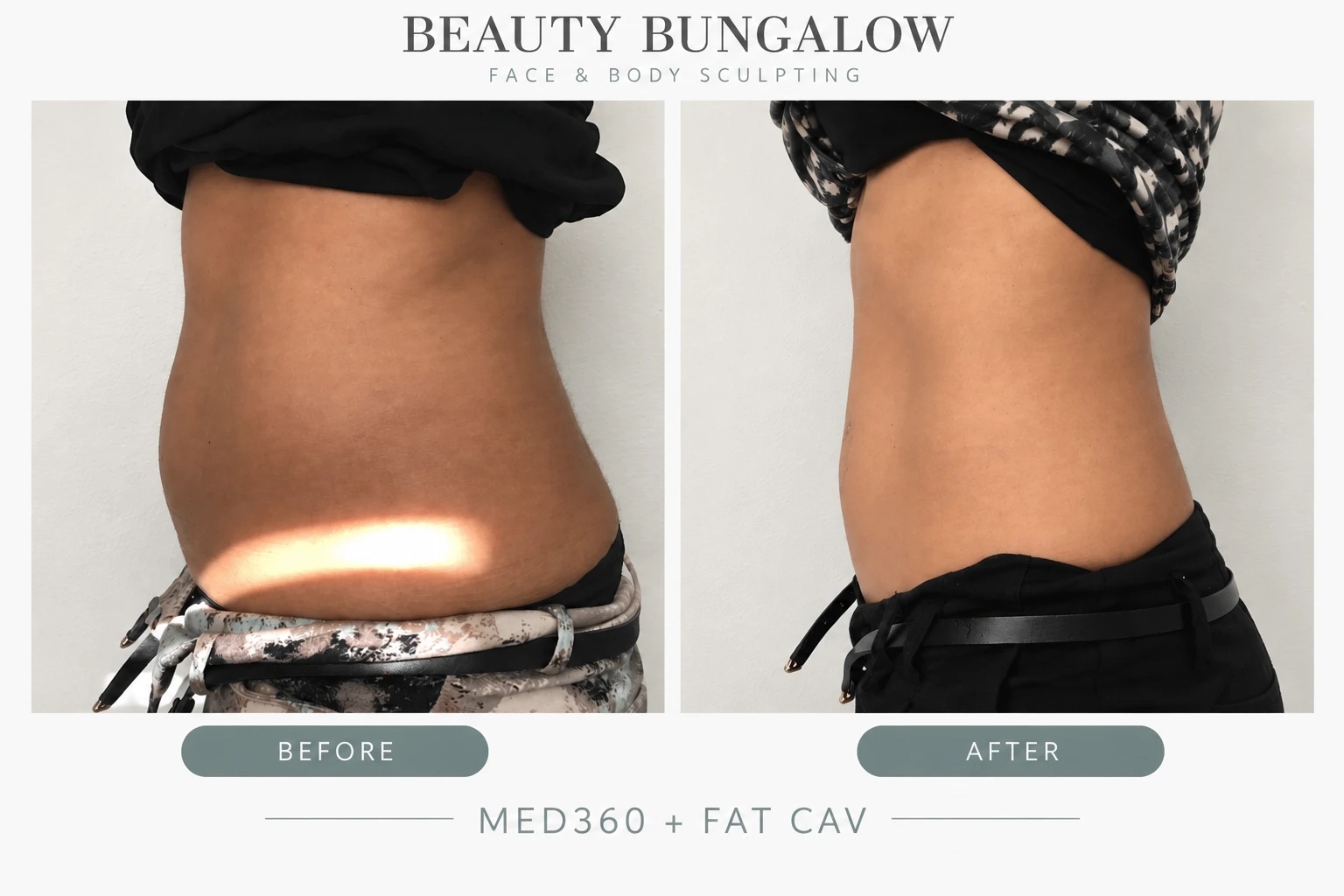 MED 360 and fat cavitation combined body sculpting before and after — abdomen & waist, side view