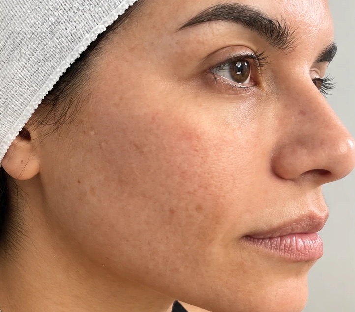 Before microneedling with PRP — tone & glow