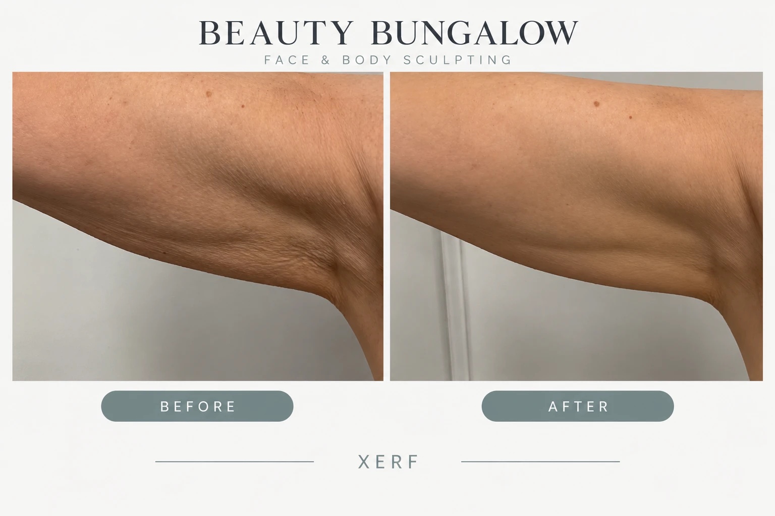 XERF arm skin tightening before and after — underarm