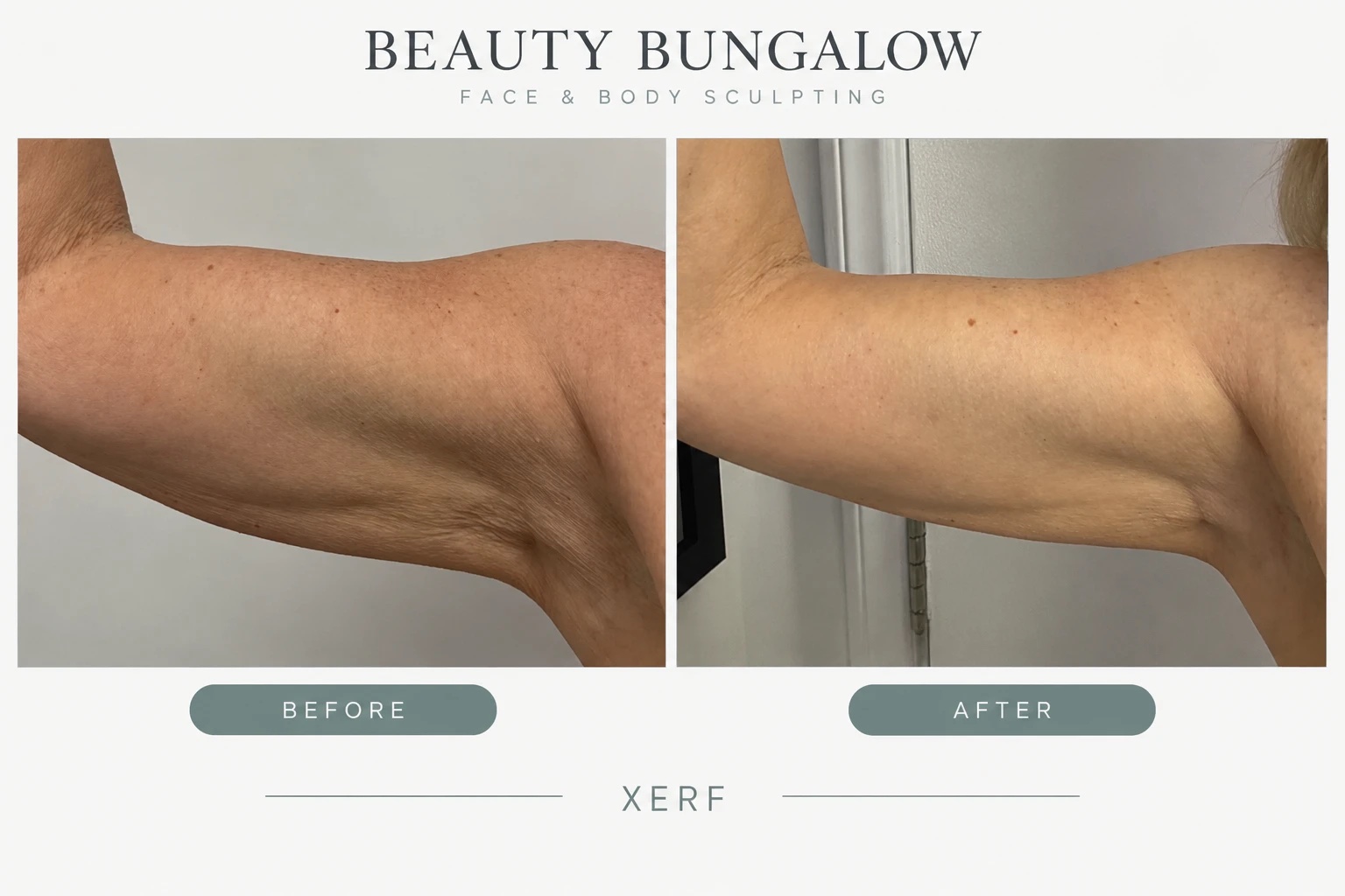 XERF arm skin tightening before and after — upper arm