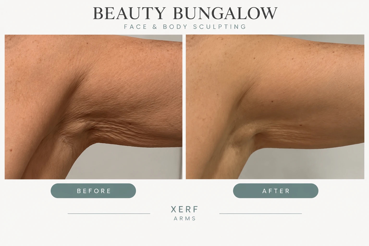 XERF arm skin tightening before and after — arms, underarm crepe