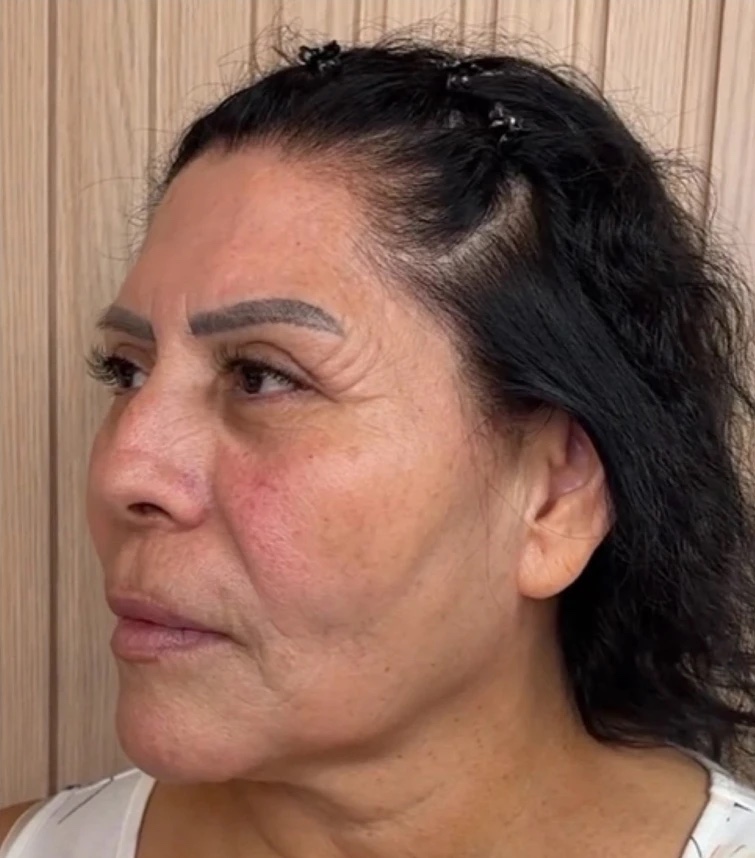 Before XERF skin tightening — full face & cheeks