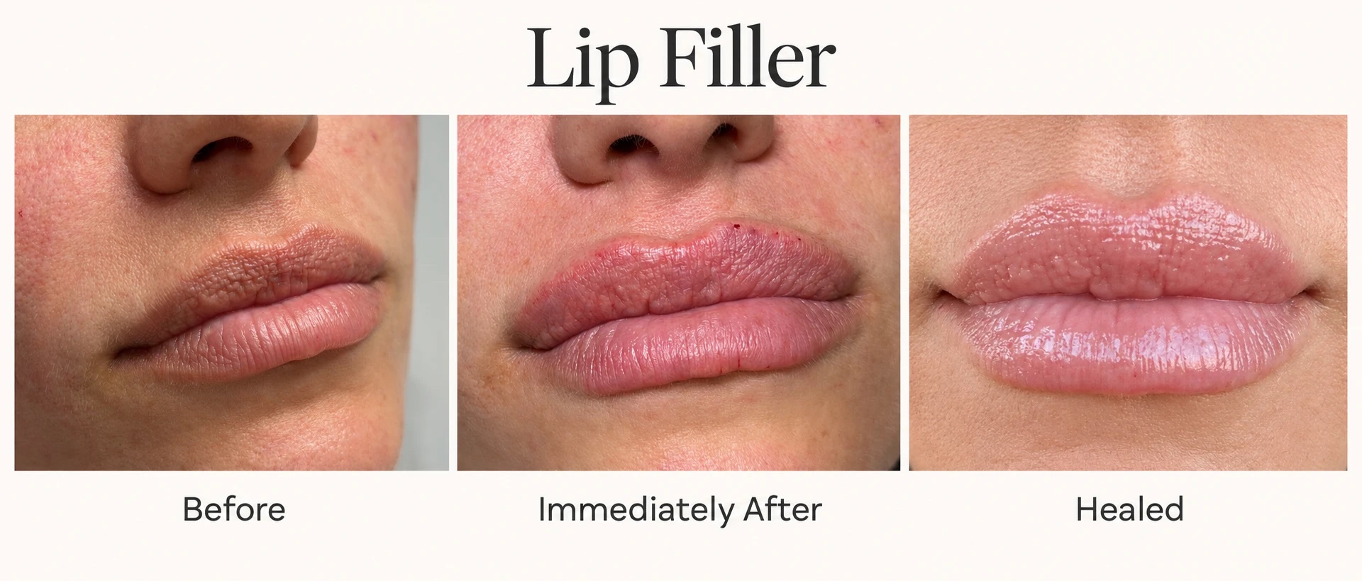 Lip filler before and after healed result, Beauty Bungalow Tustin patient