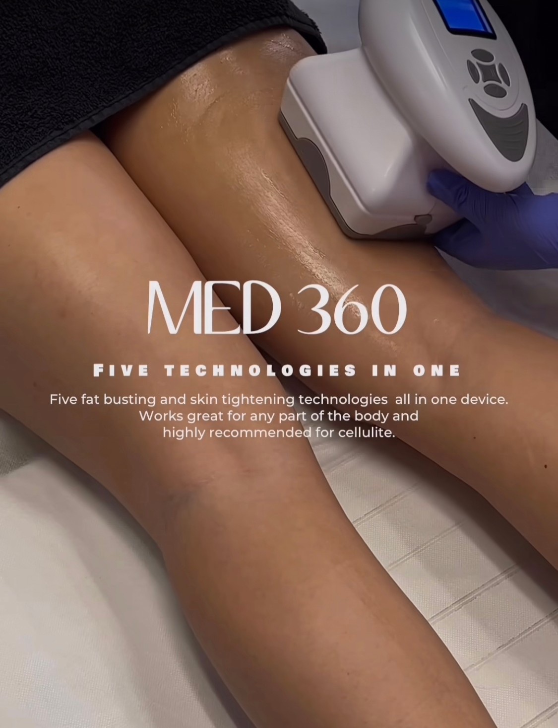 MED 360 treating the legs — highly recommended for cellulite