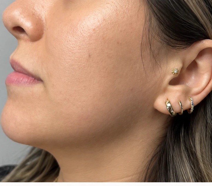 After microneedling — Microneedling with PRP · acne & scarring