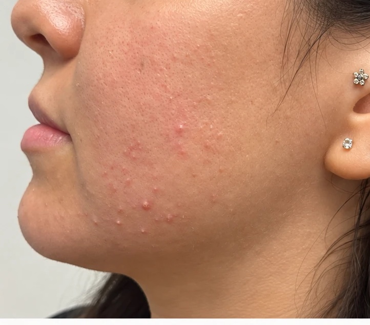 Before microneedling — Microneedling with PRP · acne & scarring