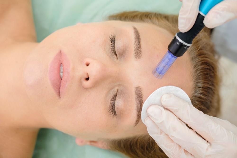 A microneedling pen treatment at Beauty Bungalow in Tustin