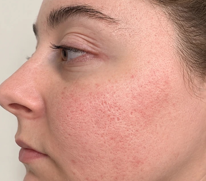 Before microneedling — Microneedling · texture & pores