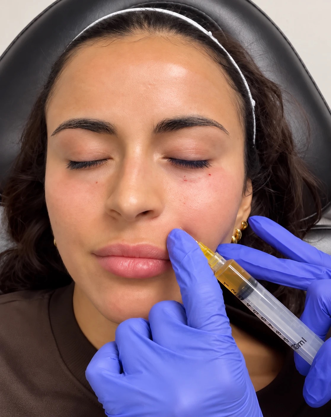 A PRF injection being placed under the eye at Beauty Bungalow